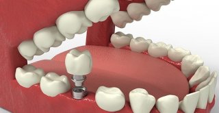 Balıkesirli Diş Hastalarına İmplant Müjdesi
