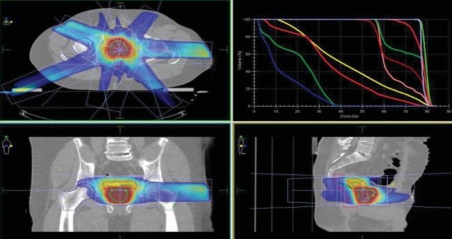 Prof. Dr. Yavuz: Prostat Kanserine Işınla Hızlı Tedavide Avantajlı Sonuçlar Elde Edilebiliyor